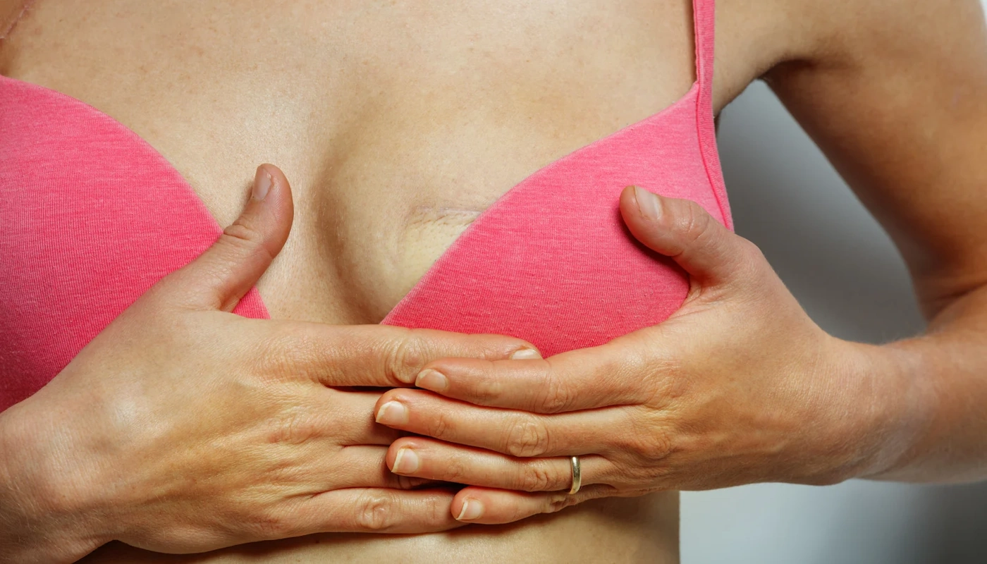 Sinə Rekonstruksiyası ilə döşün simmetriyası və estetik görünüşü bərpa edilir