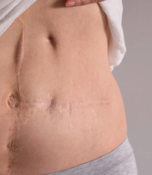 Yanıq izlərinin bərpası Plastik əməliyytalar - Yanıq izlərinin bərpası