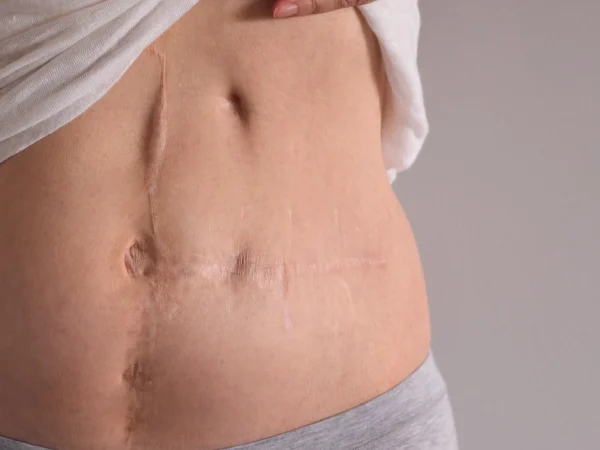 Plastik əməliyytalar - Yanıq izlərinin bərpası